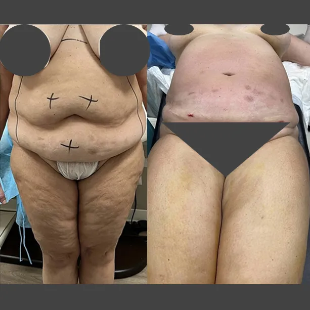 Intervento svolto in anestesia con sedazione, durata 2:20 h. In questo caso specifico la paziente presenta degli accumuli localizzati nella zona dell'addome e dei fianchi. I fori di entrata delle microcannule sono stati effettuati all'interno degli slip così da essere poco visibili. Miglioramento notevole dei parametri ematici.