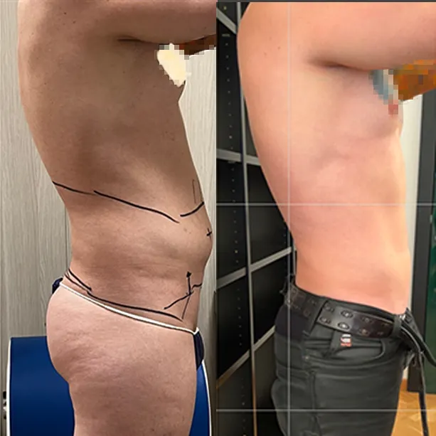 Intervento svolto in anestesia locale con sedazione, durata 1:30 h. In questo caso specifico il paziente presenta degli accumuli localizzati nella zona addome e fianchi. I fori di entrata delle microcannule sono stati effettuati all'interno degli slip così da essere poco visibili. In questo caso, più il fianco che l'addome risultava un problema psicologico per il paziente.