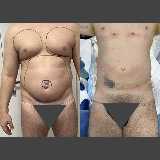 Intervento svolto in anestesia locale con sedazione, durata 2:15 h. In questo caso specifico il paziente presenta degli accumuli localizzati nella zona addome, fianchi e pettorale. I fori di entrata delle microcannule sono stati effettuati nella parte interna del pettorale (sono più evidenti perchè all'inizio risultano arrossati ma andranno a sparire nel tempo) e all'interno degli slip così da essere poco visibili.