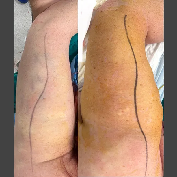 Intervento svolto in anestesia locale con sedazione, durata 1 h. In questo caso specifico la paziente presenta degli accumuli localizzati nella zona delle braccia. I fori di entrata delle microcannule sono stati effettuati nella zona del gomito.