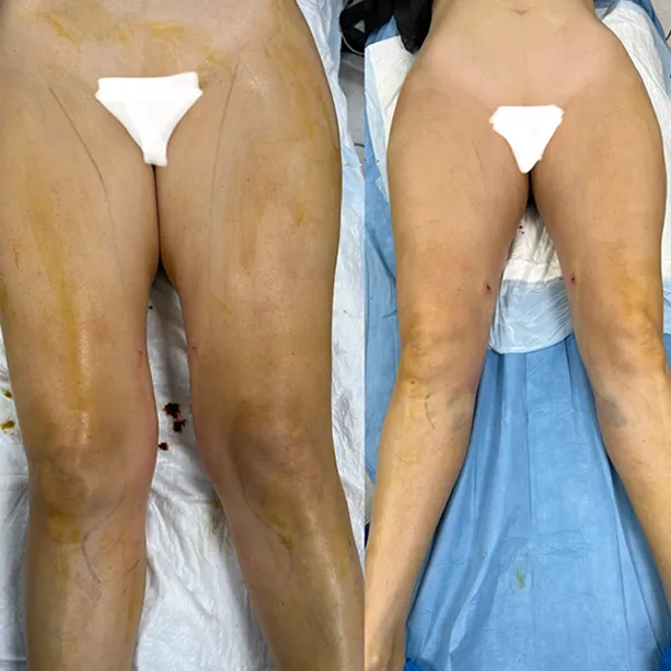 Intervento svolto in anestesia locale con sedazione, durata 2 h. In questo caso specifico la paziente presenta degli accumuli localizzati nella zona delle cosce, più precisamente nella zona interna della coscia e del ginocchio. I fori di entrata delle microcannule sono stati effettuati nella parte mediana della coscia e nella zona alta delle ginocchia (i fori sono più evidenti perchè all'inizio risultano arrossati ma andranno a sparire nel tempo). Riduzione della circonferenza delle cosce e del polpaccio per migliorare la circolazione.