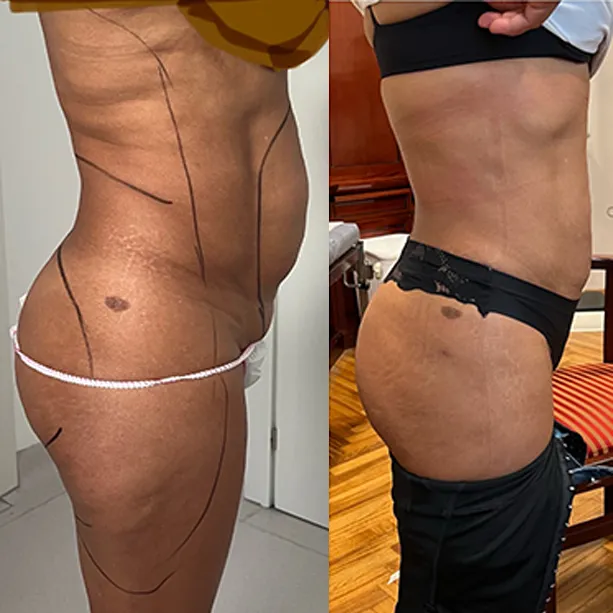 Intervento svolto in anestesia locale con sedazione, durata 1:55 h. In questo caso specifico la paziente presenta degli accumuli localizzati nella zona addome, fianchi e schiena.  I fori di entrata delle microcannule sono stati effettuati all'interno degli slip così da essere poco visibili e a livello del reggiseno. I risultati nella foto del post intervento sono a distanza di due mesi con ancora margine di miglioramento, abbiamo ottenuto un notevole miglioramento psicofisico.