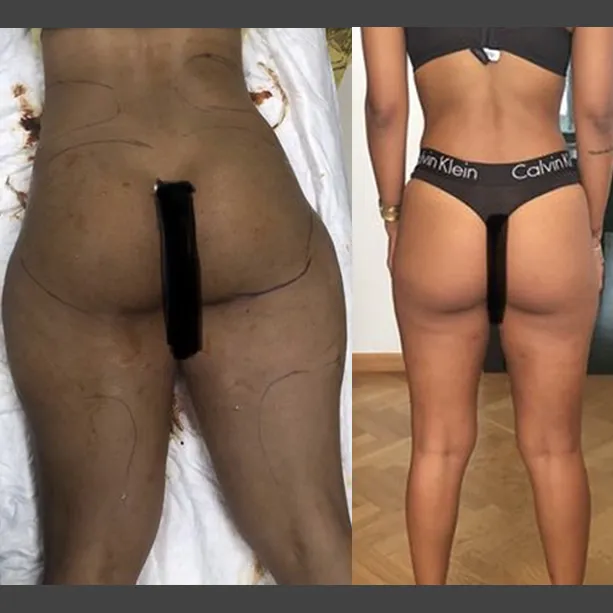 Intervento svolto in anestesia locale con sedazione, durata circa 2 h. In questo caso specifico la paziente presenta degli accumuli localizzati nella zona fianchi, culotte de cheval, sottogluteo ed interno coscia. I fori di entrata delle microcannule sono stati effettuati all'interno degli slip così da essere poco visibili, nella parte mediana della coscia e nella piega del sottogluteo. La paziente ha cambiato completamente le forme, ha avuto un notevole miglioramento anche come Lipedema.