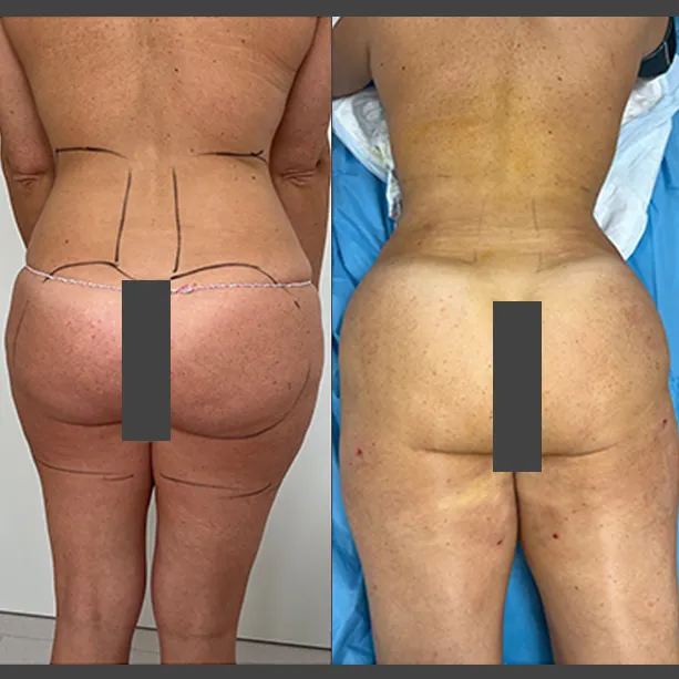 Intervento svolto in anestesia locale con sedazione, durata 1:45 h. In questo caso specifico la paziente presenta degli accumuli localizzati nella zona fianchi, culotte de cheval, interno coscia e sottogluteo. I fori di entrata delle microcannule sono stati effettuati all'interno degli slip così da essere poco visibili, nella piega del sottogluteo e nella parte mediana della coscia.