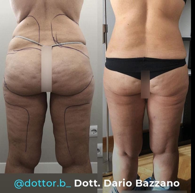 Intervento svolto in anestesia locale con sedazione, durata circa 2 h. In questo caso specifico la paziente presenta degli accumuli localizzati nella zona fianchi, culotte de cheval, sottogluteo ed interno coscia. I fori di entrata delle microcannule sono stati effettuati all'interno degli slip così da essere poco visibili, nella parte mediana della coscia e nella piega del sottogluteo. La paziente ha cambiato completamente le forme, ha avuto un notevole miglioramento anche come Lipedema.