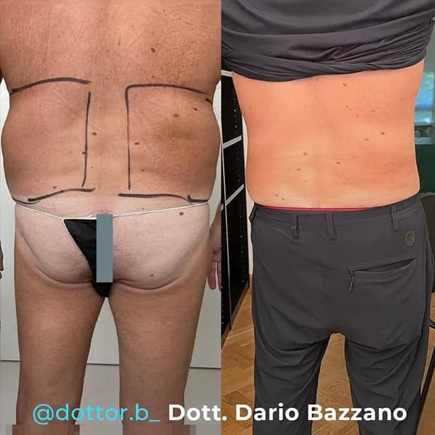 Intervento svolto in anestesia locale con sedazione, durata 1:15 h. In questo caso specifico il paziente presenta degli accumuli localizzati nella zona delle maniglie dell'amore. I fori di entrata delle microcannule sono stati effettuati nella zona dei fianchi.