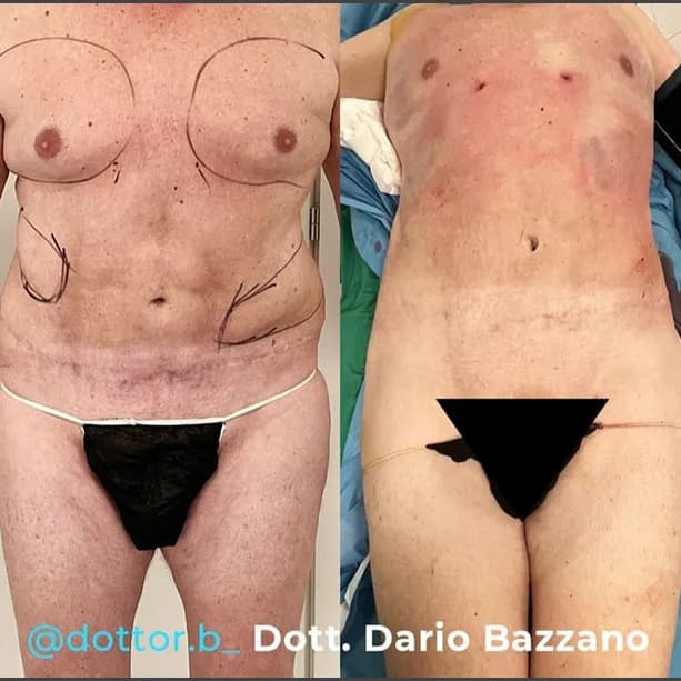 Intervento svolto in anestesia locale con sedazione, durata 1:50 h. In questo caso specifico il paziente presenta degli accumuli localizzati nella zona pettorale e fianchi. I fori di entrata delle microcannule sono stati effettuati nell'interno della zona del pettorale e nella zona dei fianchi. Il paziente presentava difetti arrecati da un altro Chirurgo Plastico; in questo caso ho sistemato le zone compromesse.
